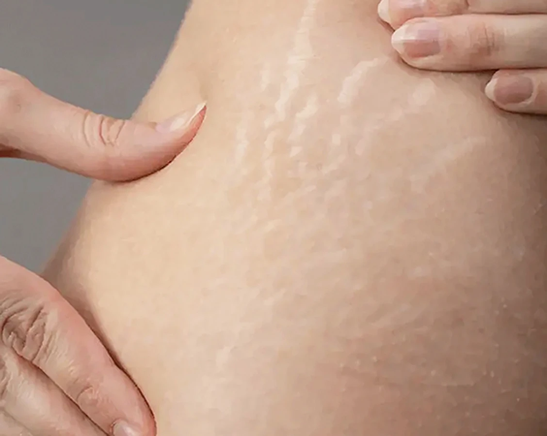 Dermo-vergetures Dermopigmentation vergetures