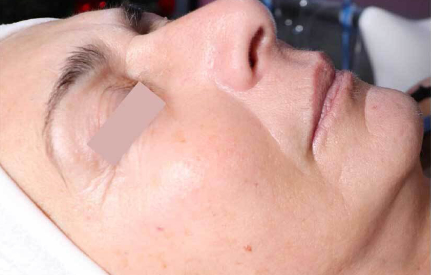 JetPeel Visage Après