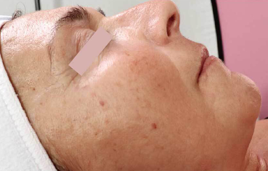 JetPeel Visage Avant