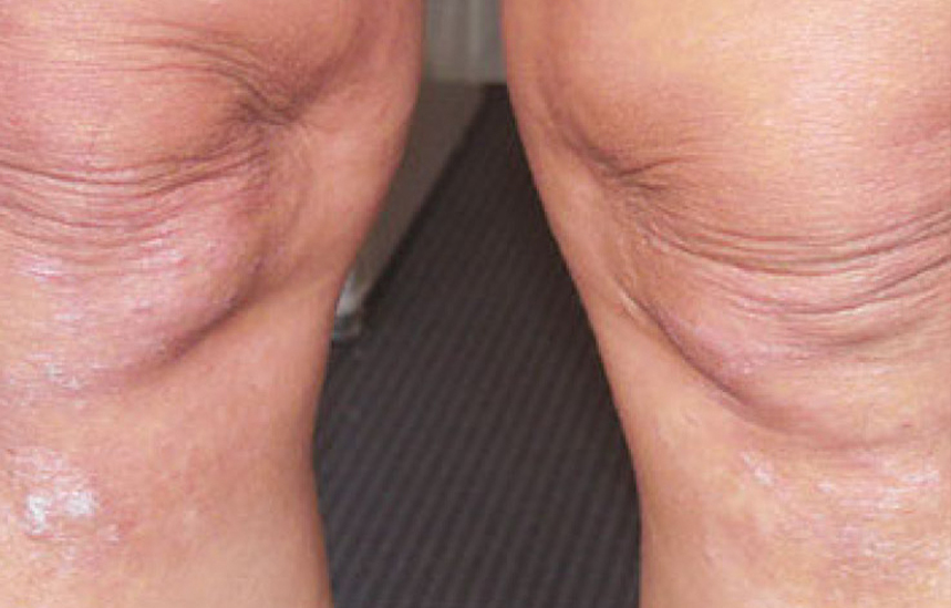 Rejulight psoriasis Après
