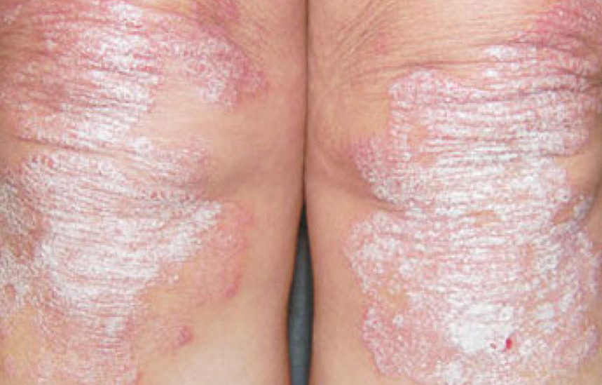 Rejulight psoriasis Avant