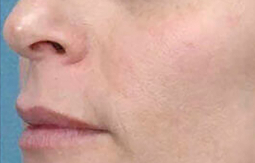 Skin Ethik visage Après