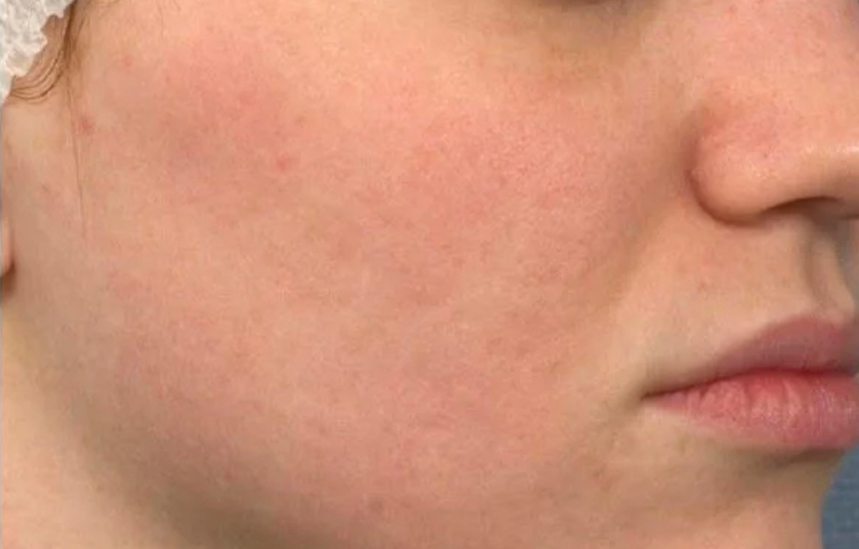 Skin Ethik visage 1 après