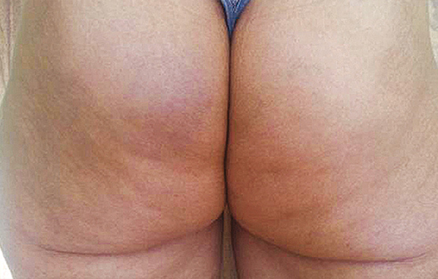 Twin Slim Fessier Après