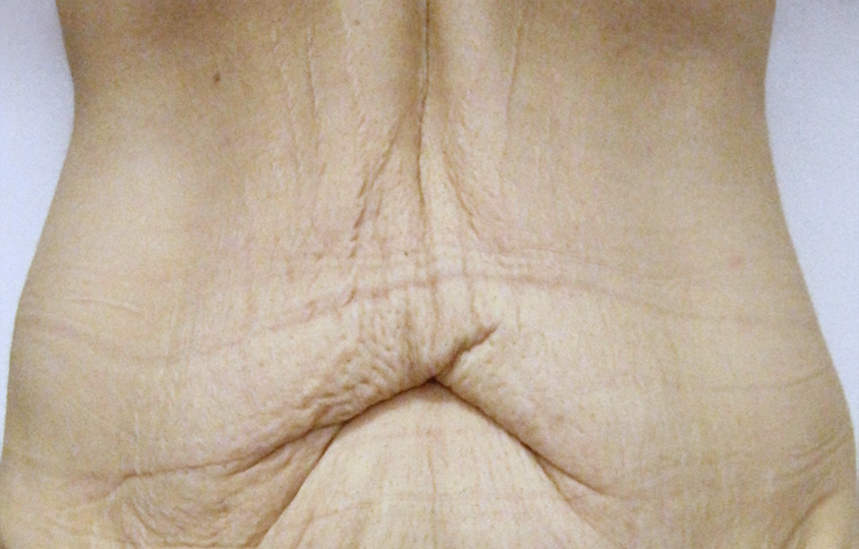 TwinSlim Ventre Avant